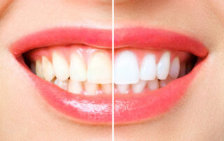 Teeth Whitening Process