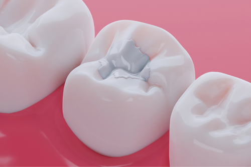 composite resin Tooth Fillings