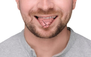 How to Prevent Dry Mouth - Dry Mouth Symptom of Man Showing Dehydrated Tongue