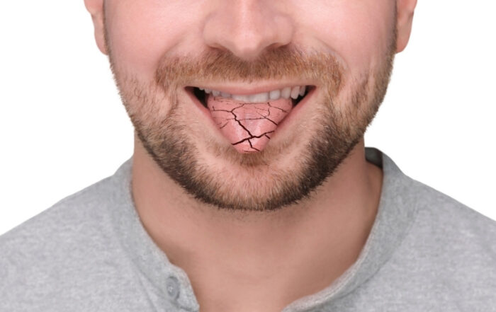 How to Prevent Dry Mouth - Dry Mouth Symptom of Man Showing Dehydrated Tongue